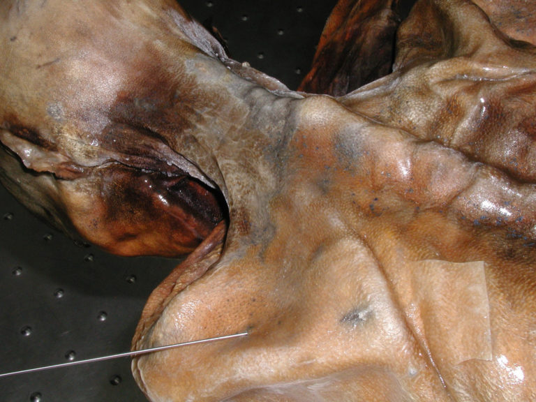 Ötzi zemřel na krvácení do mozku.