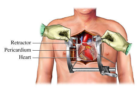 Perikardiální okno, foto heart-valve-surgery.com