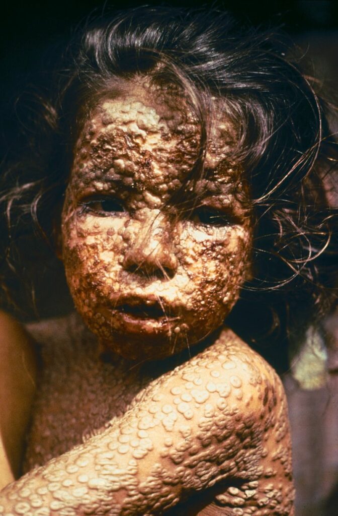 Dívka postižená pravými neštovicemi, foto CDC/James Hicks  / Creative Commons / Volné dílo