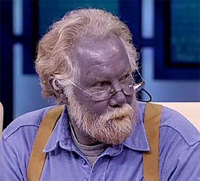 Modrá kůže není lékařům neznámá, způsobit ji může například nadměrné působení chemických sloučenin prvku stříbra nebo stříbrného prachu, foto Kevyn Jacobs / Creative Commons / Fair use